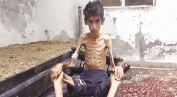 Victim of hunger in beseiged Madaya