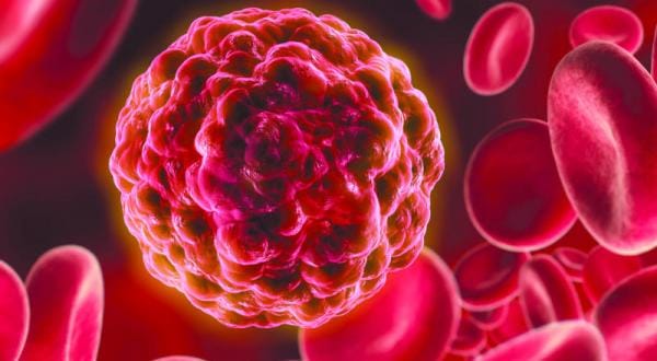 New Treatment Promising Prostate Cancer-Free Body in 90 Minutes