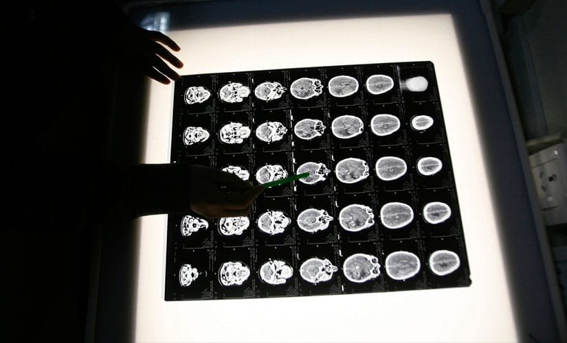 Cardiovascular Diseases Inflict Brain Health Damage
