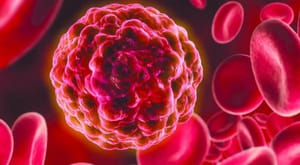 New Treatment Promising Prostate Cancer-Free Body in 90 Minutes