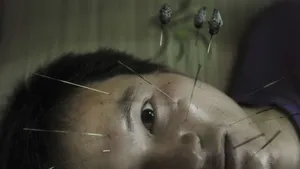 Acupuncture…Another Option to Alleviate Pain